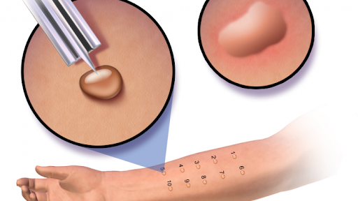 Test lẩy da là phương pháp phổ biến để chẩn đoán dị ứng.png